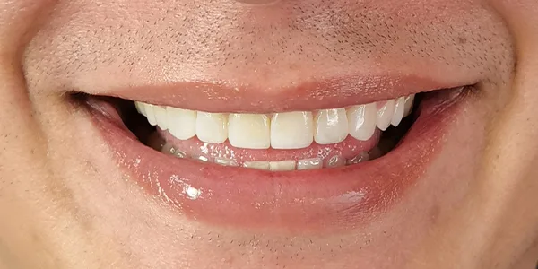 img-Blanqueamiento-dental-Bogota-3D