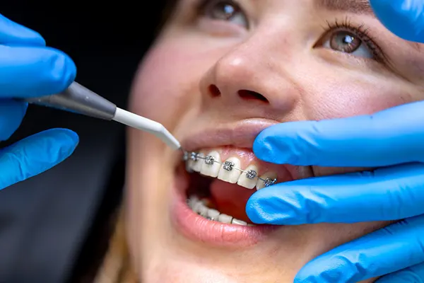 Una de las preguntas más comunes tras finalizar un tratamiento ortodóncico es: ¿se puede hacer un diseño de sonrisa después de una ortodoncia? Aunque los dientes ya están alineados, muchos...