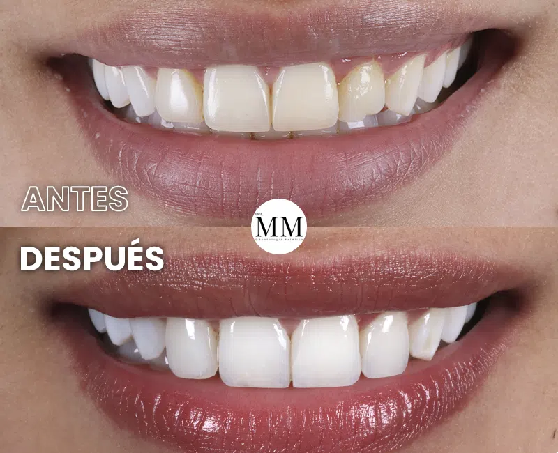 Img-DraMariaMarin-Antes&Despues-2026-Diseño_de_Sonrisa-11 Img-DraMariaMarin-Antes&Despues-2026-Diseño_de_Sonrisa-11