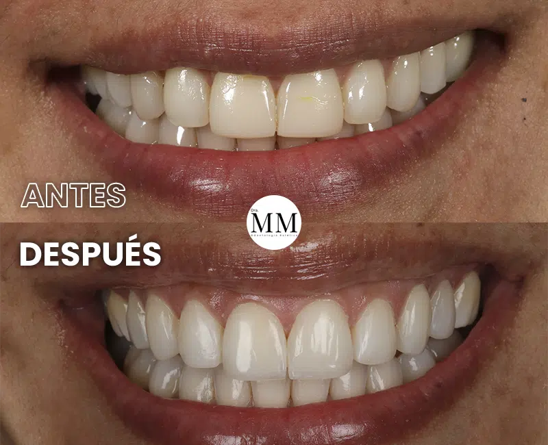 Img-DraMariaMarin-Antes&Despues-2026-Diseño_de_Sonrisa-9 Img-DraMariaMarin-Antes&Despues-2026-Diseño_de_Sonrisa-9