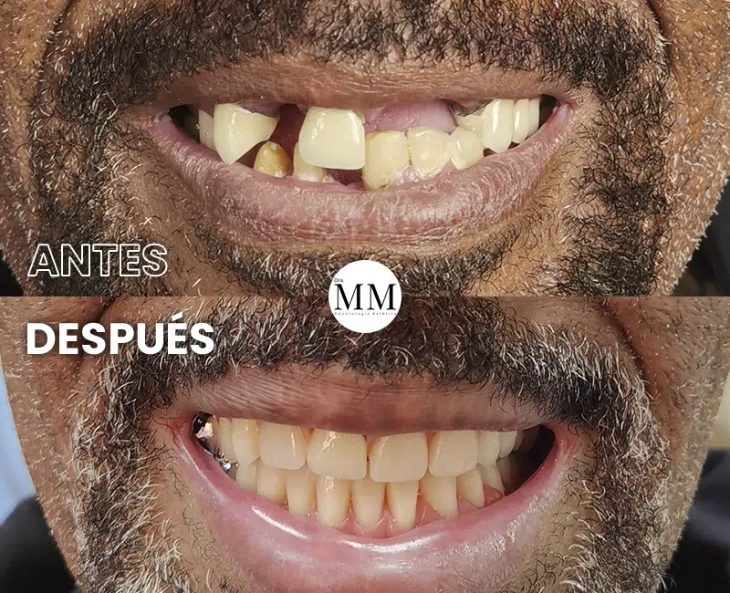 Img-DraMariaMarin-Antes&Despues-2026-Implantes_Dentales-1 Img-DraMariaMarin-Antes&Despues-2026-Implantes_Dentales-1