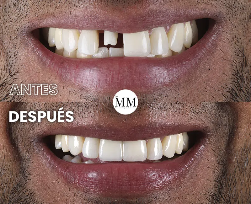 Img-DraMariaMarin-Antes&Despues-2026-Implantes_Dentales-2 Img-DraMariaMarin-Antes&Despues-2026-Implantes_Dentales-2